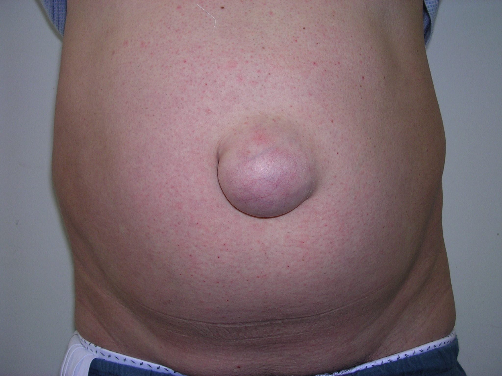 Best Umbilical Hernia Surgeon in Delhi NCR